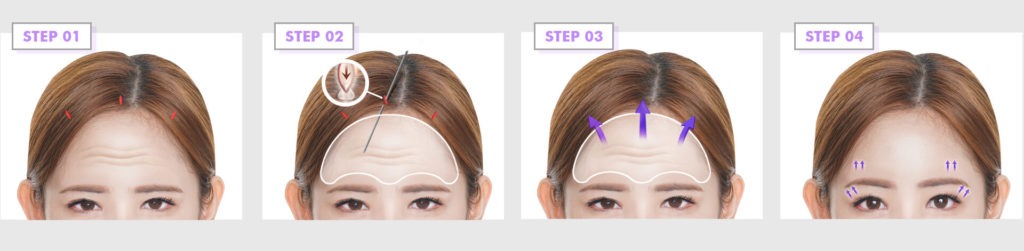 forehead lift in Istanbul
