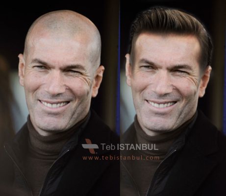 Zidane before and after Hair Transplant in Istanbul